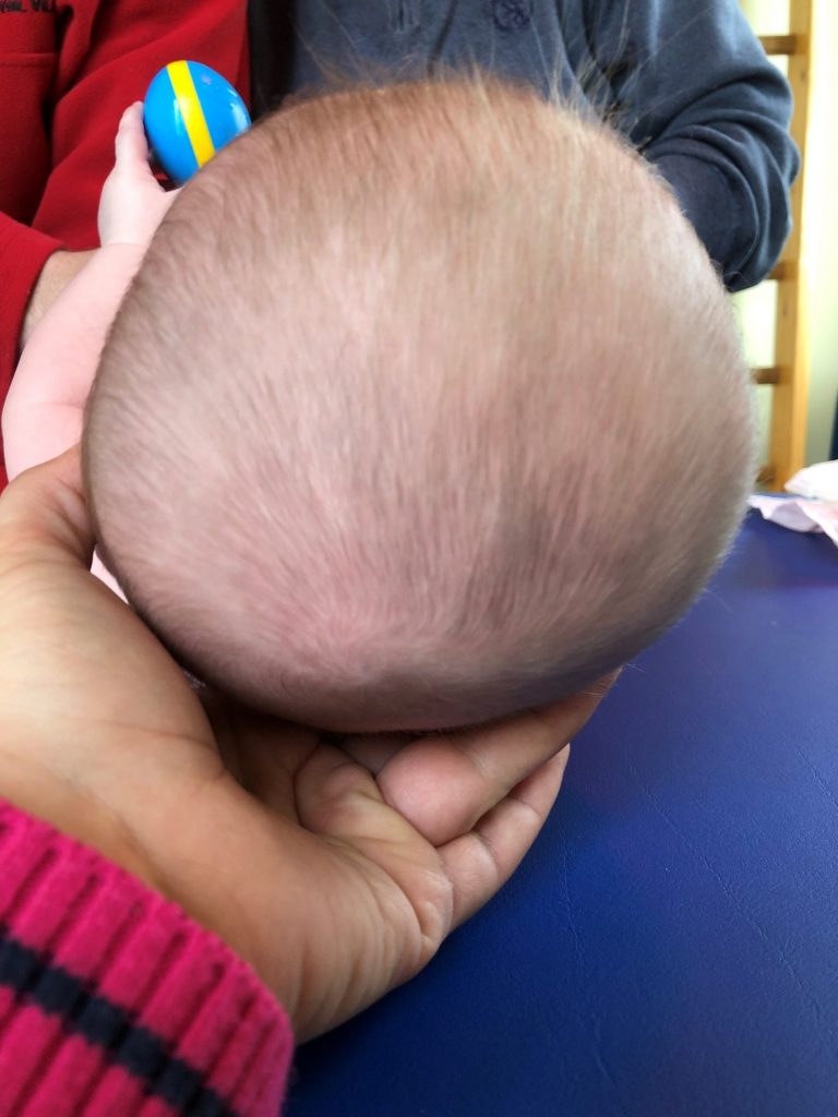 Hier sieht man einen Kopf eines Säuglings mit Vorzughaltung
