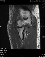 MRT-zur-Ellenbogenfraktur
